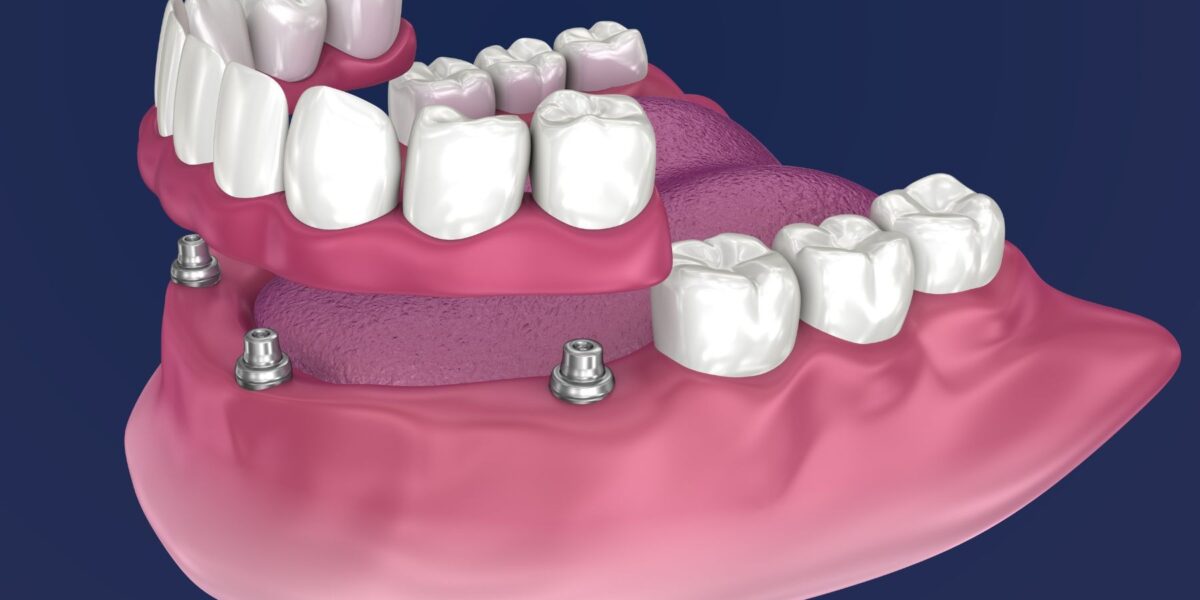 Proteza overdenture