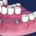 Proteza overdenture